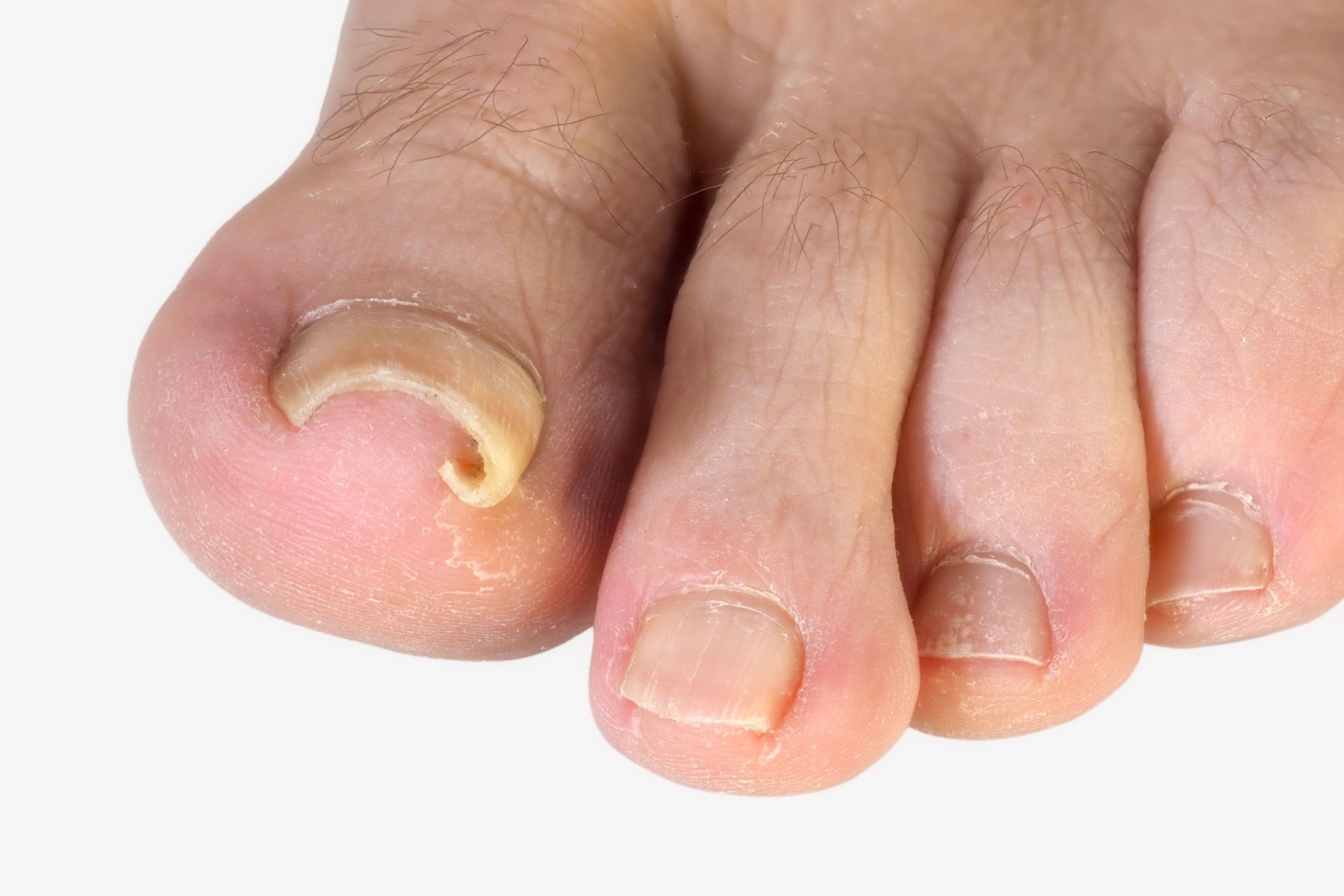 Involuted and / or Ingrowing toenail