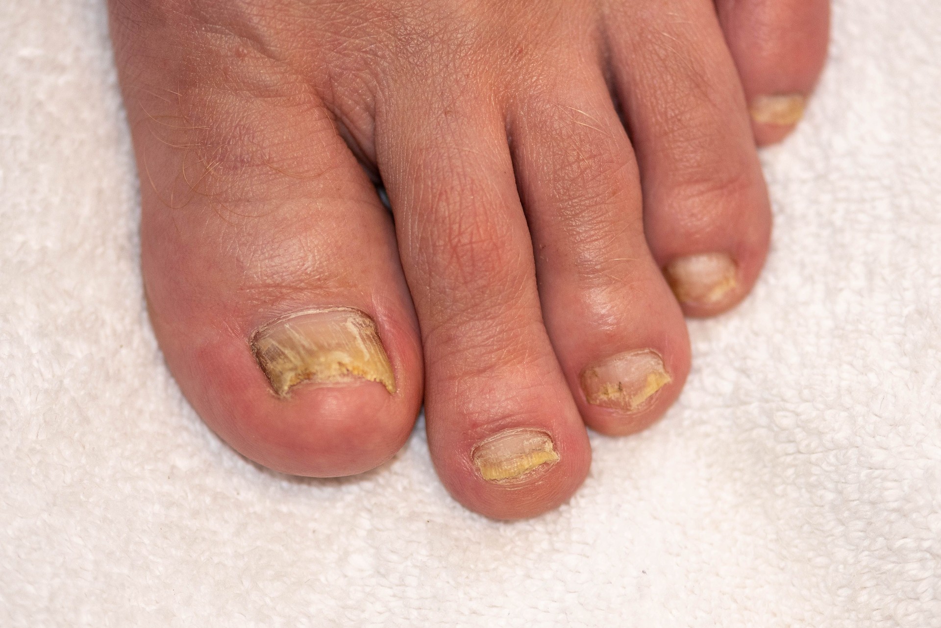 Fungal Nail Infection - Toenail fungus.