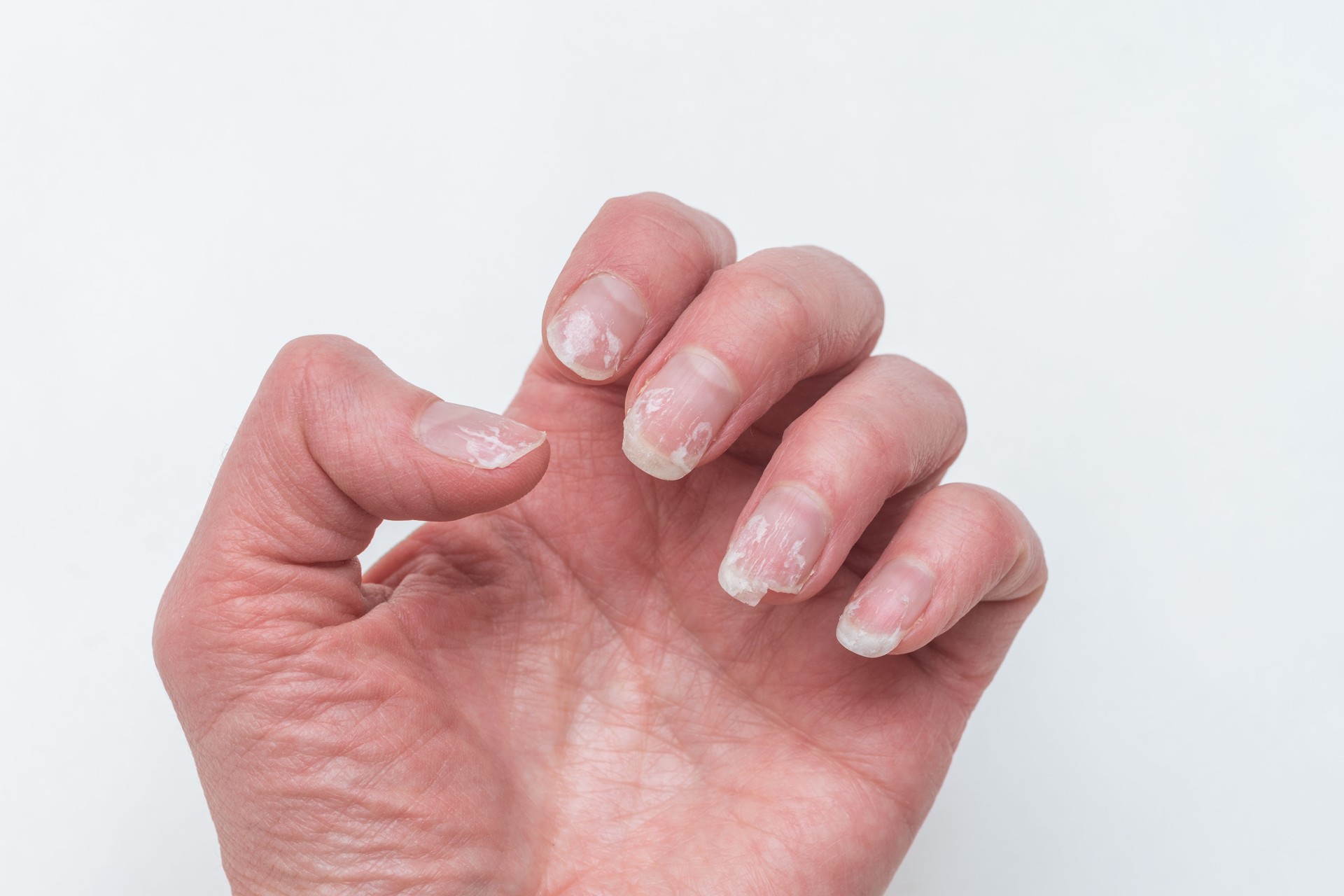 Damaged Nails requiring treatment and care